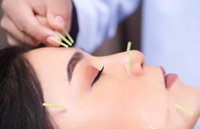 Facial Acupuncture As Anti Wrinkle Treatment