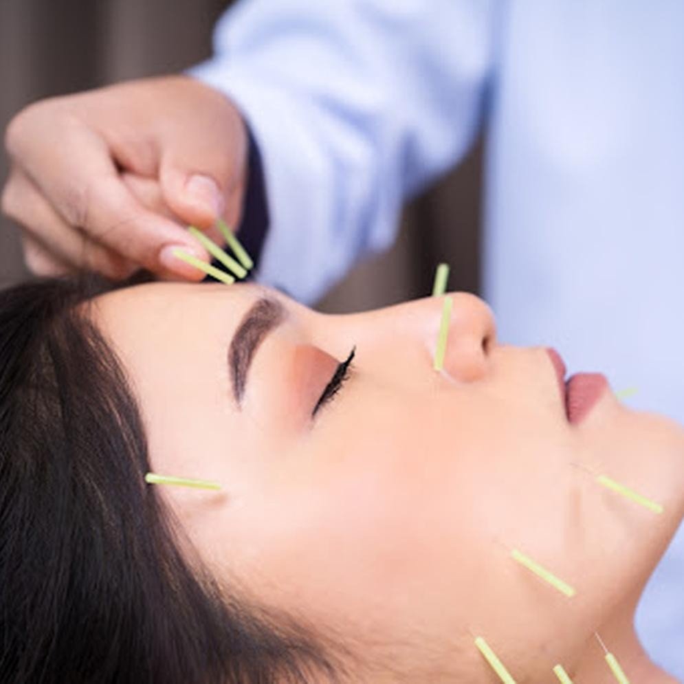 Facial Acupuncture As Anti Wrinkle Treatment