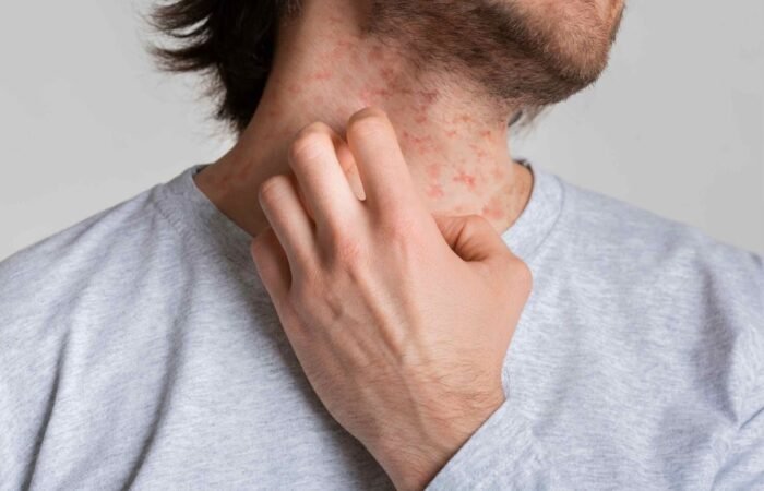 How Acupuncture Can Soothe Your Eczema Symptoms