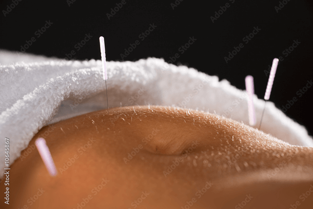 How Acupuncture Helps in Your Weight Loss Journey