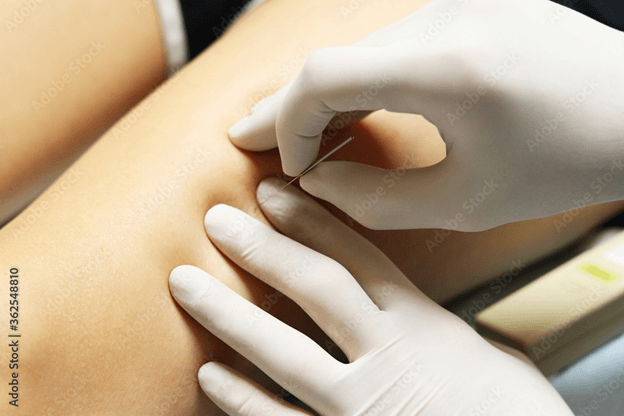 What is dry needling