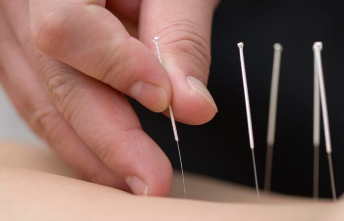 Acupuncture for Osteoporosis