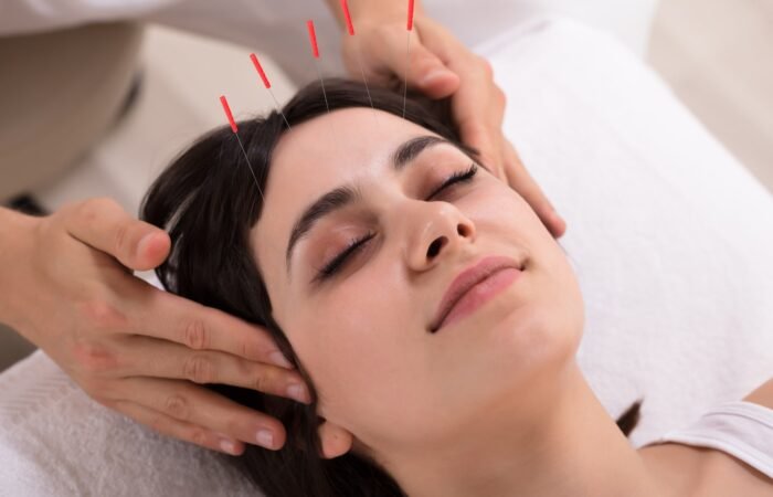 An acupuncturist inserts fine needles into acupoints on the head to enhance circulation and support natural blood pressure regulation.