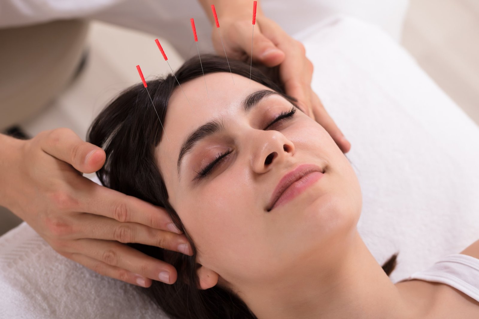 An acupuncturist inserts fine needles into acupoints on the head to enhance circulation and support natural blood pressure regulation.