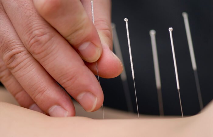 A TCM practitioner inserting acupuncture needles into specific meridian points that support and manage heart health