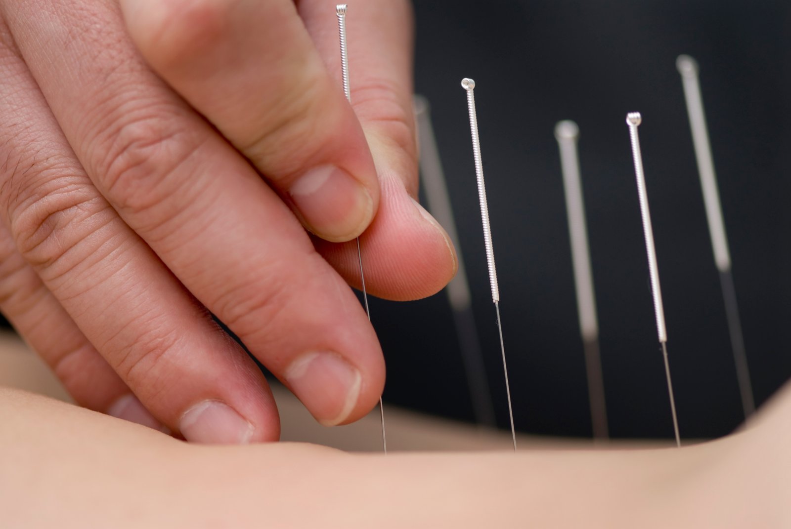 A TCM practitioner inserting acupuncture needles into specific meridian points that support and manage heart health