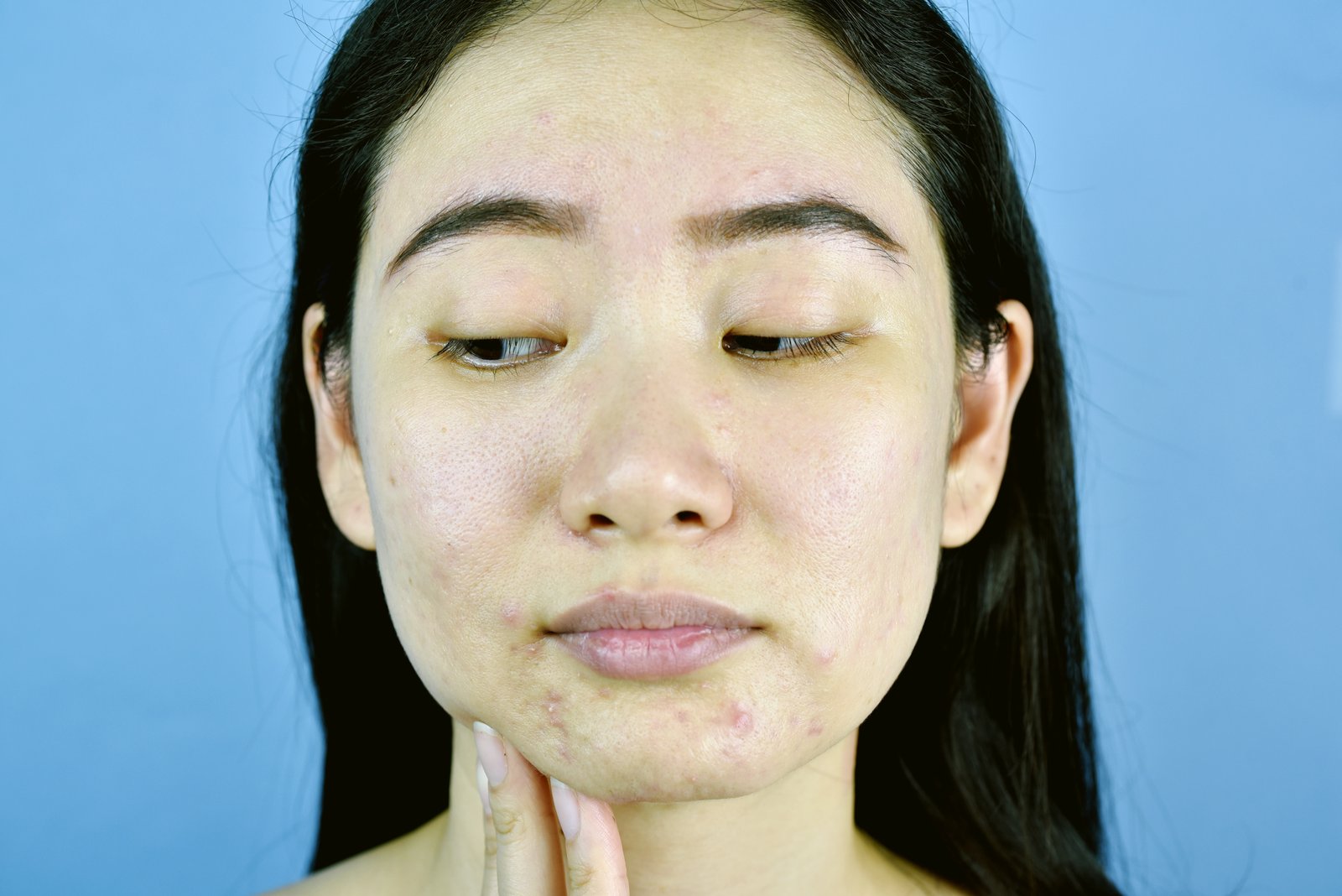 A woman appears frustrated with the appearance of hormonal acne on her chin and jaw