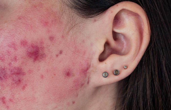 Close-up of a woman’s face showing inflamed hormonal acne, illustrating skin concerns that can be addressed by holistic and Western treatments
