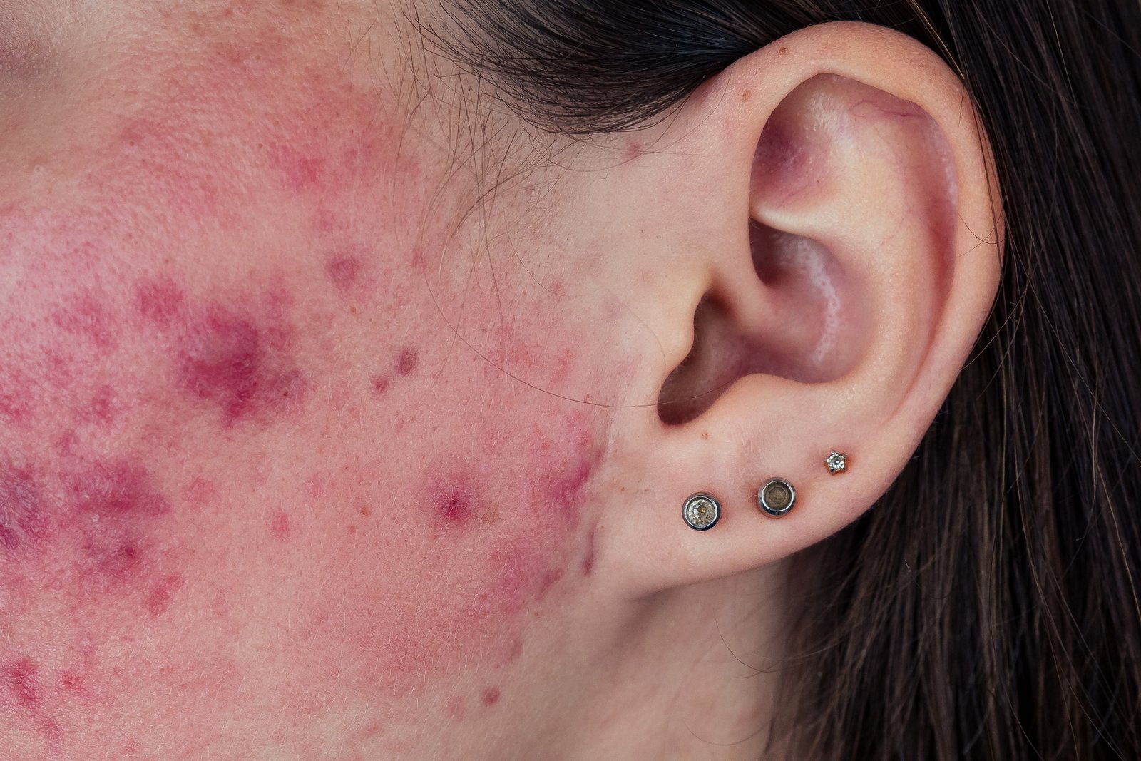 Close-up of a woman’s face showing inflamed hormonal acne, illustrating skin concerns that can be addressed by holistic and Western treatments