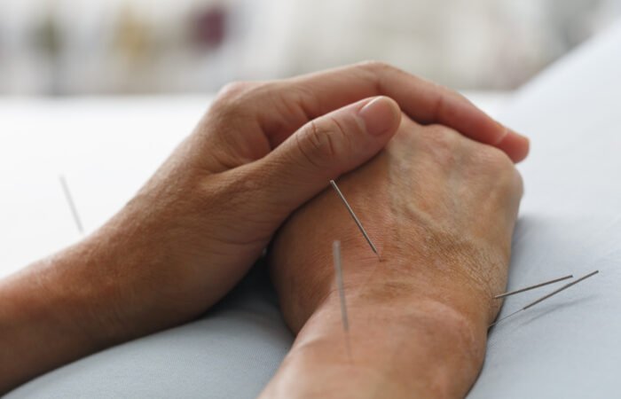 Close-up of acupuncture needles on a patient's hand, an ancient therapy used to naturally balance blood pressure