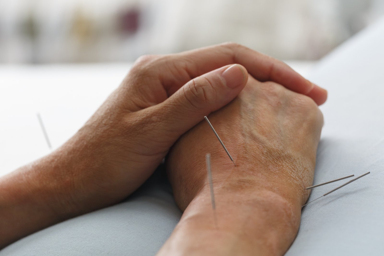 Close-up of acupuncture needles on a patient's hand, an ancient therapy used to naturally balance blood pressure